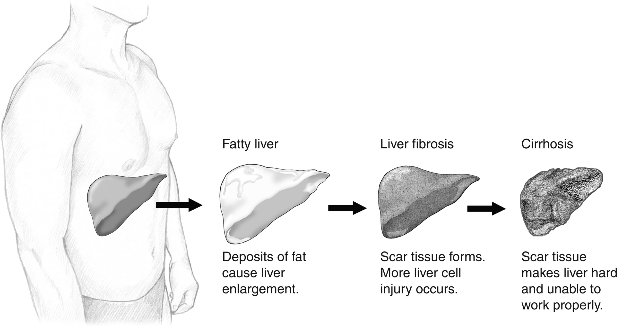 Illustration of the stages of liver damage: normal liver, fatty liver (where deposits of fat cause liver enlargement), liver fibrosis (where scar tissue forms and more liver cell injury occurs), and cirrhosis (where scar tissue makes the liver hard).