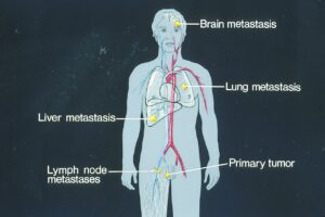 Rysunek medyczny przedstawiający potencjalne lokalizacje przerzutów nowotworowych w organizmie człowieka.